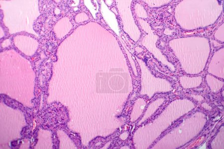 Photo for Photomicrograph of an endemic goiter tissue sample under a microscope, revealing thyroid gland abnormalities, including thyroid follicular cell hyperplasia and colloid-filled follicles. - Royalty Free Image