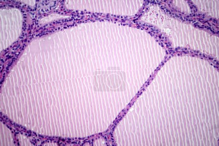 Photo for Photomicrograph of an endemic goiter tissue sample under a microscope, revealing thyroid gland abnormalities, including thyroid follicular cell hyperplasia and colloid-filled follicles. - Royalty Free Image