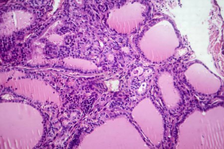 Foto de Fotomicrografía de una muestra de tejido de bocio tóxico bajo un microscopio, revelando hipertrofia de las células foliculares tiroideas, aumento de la vascularización y depleción de coloides. - Imagen libre de derechos