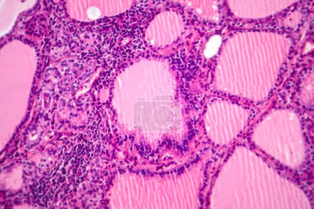 Photo for Photomicrograph of a toxic goiter tissue sample under a microscope, revealing hypertrophy of thyroid follicular cells, increased vascularity, and colloid depletion. - Royalty Free Image
