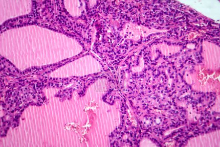 Téléchargez les photos : Photomicrographie d'un échantillon de tissu goitre toxique au microscope, révélant une hypertrophie des cellules folliculaires thyroïdiennes, une augmentation de la vascularisation et une déplétion colloïdienne. - en image libre de droit