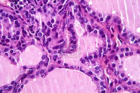 Foto de Fotomicrografía de una muestra de tejido de bocio tóxico bajo un microscopio, revelando hipertrofia de las células foliculares tiroideas, aumento de la vascularización y depleción de coloides. - Imagen libre de derechos