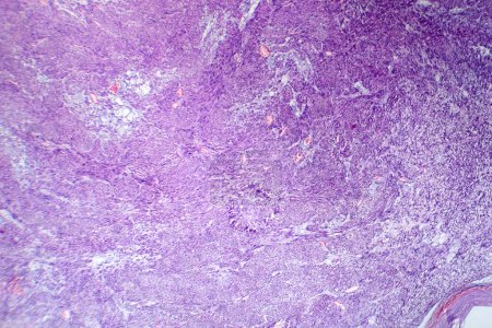 Foto de Fotomicrografía del leiomioma, que ilustra las células tumorales benignas del músculo liso dentro del tejido uterino. - Imagen libre de derechos
