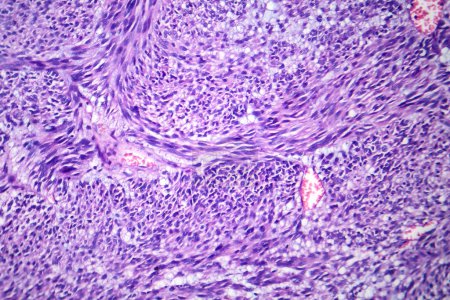 Foto de Fotomicrografía del leiomioma, que ilustra las células tumorales benignas del músculo liso dentro del tejido uterino. - Imagen libre de derechos
