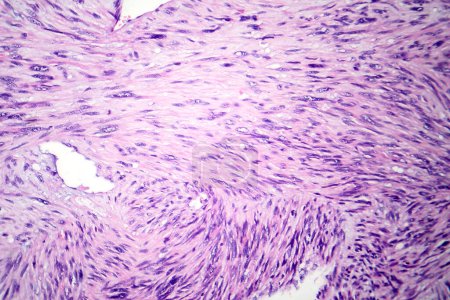 Foto de Fotomicrografía del leiomiosarcoma, que representa células tumorales malignas del músculo liso, indicativas de cáncer de tejido blando agresivo. - Imagen libre de derechos