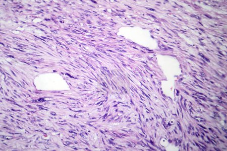 Téléchargez les photos : Photomicrographie du léiomyosarcome, représentant des cellules tumorales malignes du muscle lisse, indiquant un cancer agressif des tissus mous. - en image libre de droit