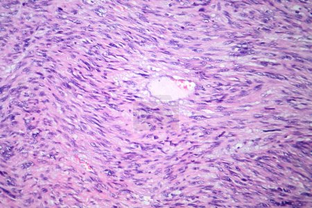 Foto de Fotomicrografía del leiomiosarcoma, que representa células tumorales malignas del músculo liso, indicativas de cáncer de tejido blando agresivo. - Imagen libre de derechos