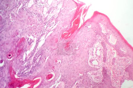 Foto de Fotomicrografía de carcinoma mucinoso en el estómago, mostrando células malignas productoras de mucina, características de un cáncer de estómago agresivo. - Imagen libre de derechos