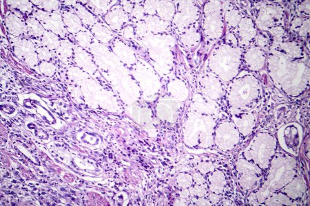 Foto de Fotomicrografía de carcinoma mucinoso en el estómago, mostrando células malignas productoras de mucina, características de un cáncer de estómago agresivo. - Imagen libre de derechos