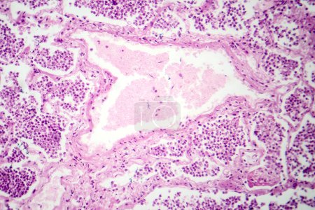 Photo for Photomicrograph of lobar pneumonia in grey hepatic phase, revealing lung tissue transition with exudate-filled alveoli. - Royalty Free Image