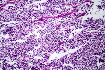 Foto de Fotomicrografía del cáncer de pulmón de células pequeñas, revelando células malignas densamente empaquetadas características de una neoplasia maligna pulmonar agresiva. - Imagen libre de derechos