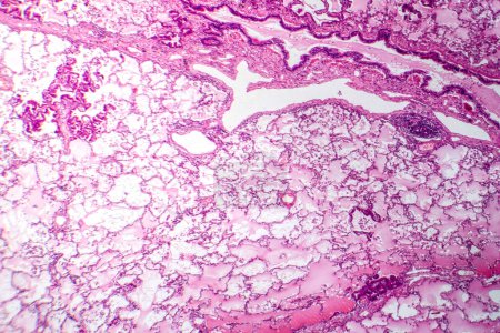 Foto de Fotomicrografía del adenocarcinoma de pulmón, que muestra células glandulares malignas indicativas del tipo más común de cáncer de pulmón. - Imagen libre de derechos