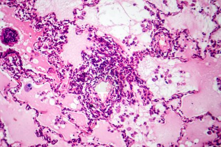 Photo for Photomicrograph of lung adenocarcinoma, displaying malignant glandular cells indicative of the most common type of lung cancer. - Royalty Free Image