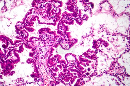 Foto de Fotomicrografía del adenocarcinoma de pulmón, que muestra células glandulares malignas indicativas del tipo más común de cáncer de pulmón. - Imagen libre de derechos