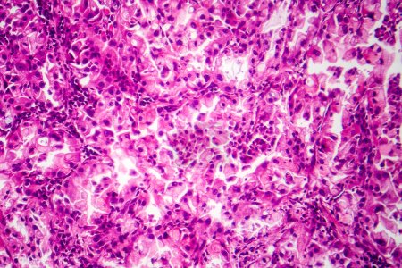 Foto de Fotomicrografía de tejido de cáncer de pulmón, revelando células malignas y el crecimiento anormal característico de malignidad pulmonar. - Imagen libre de derechos