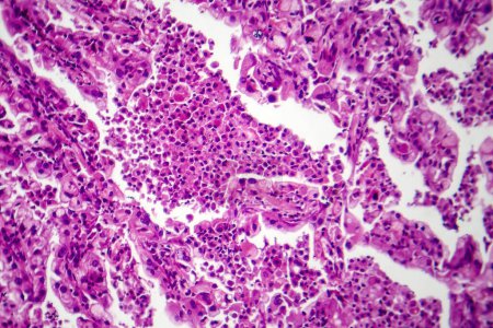 Foto de Fotomicrografía de tejido de cáncer de pulmón, revelando células malignas y el crecimiento anormal característico de malignidad pulmonar. - Imagen libre de derechos