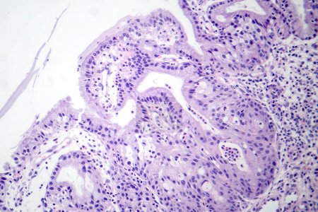 Photomicrograph of nasal polyps, displaying abnormal tissue growth in the nasal passages often causing congestion and discomfort.