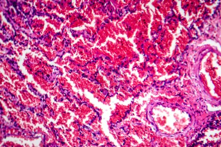 Photo for Photomicrograph of acute pulmonary hemorrhage, showing blood-filled alveoli and lung tissue damage due to bleeding. - Royalty Free Image