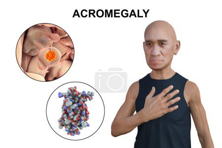 Téléchargez les photos : Acromégalie, illustration 3D montrant une augmentation de la taille des mains et du visage due à une surproduction de somatotrophine causée par une tumeur de l'hypophyse. - en image libre de droit