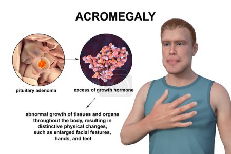 Acromégalie, illustration 3D montrant une augmentation de la taille des mains et du visage due à une surproduction de somatotrophine causée par une tumeur de l'hypophyse.