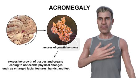 Téléchargez les photos : Acromégalie, illustration 3D montrant une augmentation de la taille des mains et du visage due à une surproduction de somatotrophine causée par une tumeur de l'hypophyse. - en image libre de droit