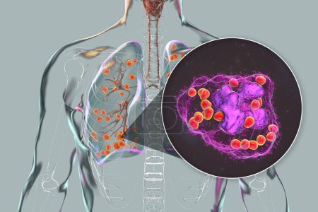 Foto de Histoplasmosis pulmonar, una infección fúngica causada por Histoplasma capsulatum. Ilustración 3D que muestra pequeños nódulos dispersos por los pulmones y levaduras de histoplasma dentro de macrófagos pulmonares. - Imagen libre de derechos