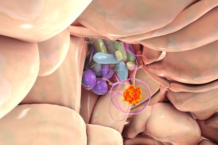 Téléchargez les photos : Une tumeur de l'hypophyse, illustration médicale 3D soulignant son emplacement et son impact sur les structures voisines. - en image libre de droit