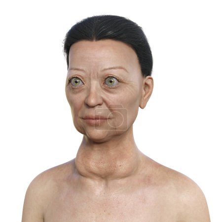 Photo for A woman with Graves' disease having enlarged thyroid gland and exophthalmos, 3D illustration. - Royalty Free Image