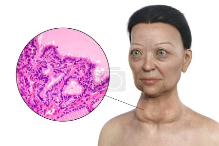 Photo for A 3D illustration of a woman with Graves' disease having enlarged thyroid gland and exophthalmos, alongside a micrograph image of thyroid tissue affected by Graves' disease. - Royalty Free Image