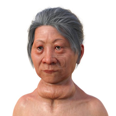 Téléchargez les photos : Une femme atteinte de la maladie de Graves ayant une glande thyroïde élargie et une exophtalmie, illustration 3D. - en image libre de droit