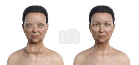 Téléchargez les photos : Une femme atteinte de la maladie de Graves ayant une glande thyroïde élargie et une exophtalmie (à gauche), et la même personne en bonne santé à titre de comparaison (à droite), illustration 3D. - en image libre de droit