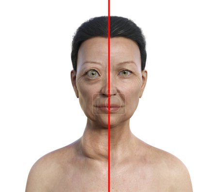 Téléchargez les photos : Une femme atteinte de la maladie de Graves ayant une glande thyroïde élargie et une exophtalmie (à gauche), et la même personne en bonne santé à titre de comparaison (à droite), illustration 3D. - en image libre de droit
