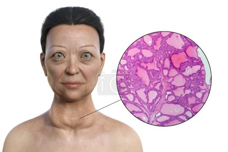 Téléchargez les photos : Illustration 3D d'une femme atteinte de la maladie de Graves présentant une hypertrophie de la glande thyroïde et une exophtalmie, accompagnée d'une image micrographique du tissu thyroïdien atteint de la maladie de Graves. - en image libre de droit