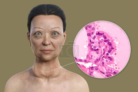 Téléchargez les photos : Illustration 3D d'une femme atteinte de la maladie de Graves présentant une hypertrophie de la glande thyroïde et une exophtalmie, accompagnée d'une image micrographique du tissu thyroïdien atteint de la maladie de Graves. - en image libre de droit