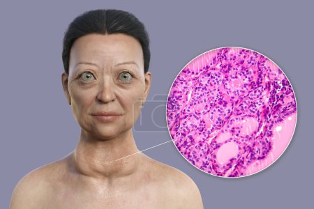Photo for A 3D illustration of a woman with Graves' disease having enlarged thyroid gland and exophthalmos, alongside a micrograph image of thyroid tissue affected by Graves' disease. - Royalty Free Image