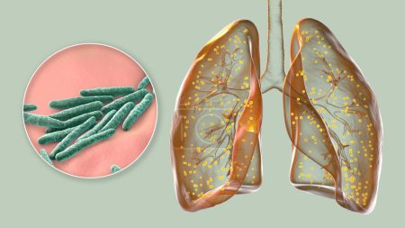 A detailed 3D photorealistic illustration showcasing human lungs affected by miliary tuberculosis, along with close-up view of Mycobacterium tuberculosis bacteria.
