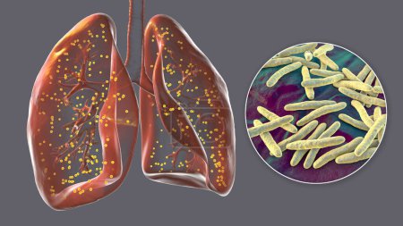 Téléchargez les photos : Une illustration photoréaliste 3D détaillée montrant les poumons humains atteints de tuberculose miliaire, ainsi qu'une vue rapprochée de la bactérie Mycobacterium tuberculosis. - en image libre de droit