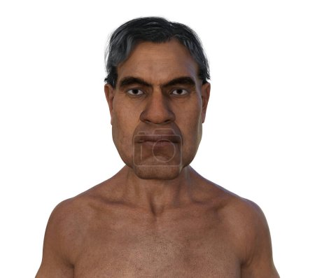 Acromégalie chez l'homme, illustration 3D montrant une augmentation de la taille des mains et du visage due à une surproduction de somatotrophine causée par une tumeur de l'hypophyse.