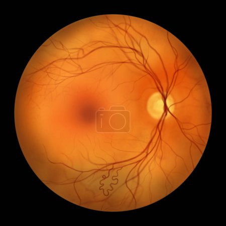 Foto de Malformación arteriovenosa retiniana: anomalías vasculares retinianas congénitas raras con vasos sanguíneos enredados en la retina, la ilustración muestra comunicación arteriovenosa sin capilares intervinientes. - Imagen libre de derechos