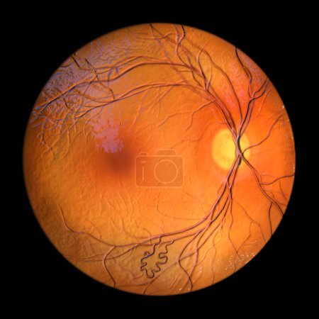 Photo for Retinal arteriovenous malformation: Rare congenital retinal vascular anomalies with tangled blood vessels in retina, 3D illustration shows artery-vein communication without intervening capillaries. - Royalty Free Image