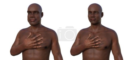 Téléchargez les photos : Acromégalie chez un homme, et le même homme en bonne santé. Illustration 3D montrant une augmentation de la taille des mains et du visage due à une surproduction de somatotrophine causée par une tumeur de l'hypophyse. - en image libre de droit