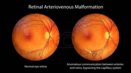 Photo for Retinal arteriovenous malformation: Rare congenital retinal vascular anomalies with tangled blood vessels in retina, 3D illustration shows artery-vein communication without intervening capillaries. - Royalty Free Image
