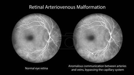 Foto de Malformación arteriovenosa retiniana, anomalías vasculares retinianas congénitas raras. Una ilustración muestra la comunicación arteriovenosa sin capilares intervinientes en la angiografía fluoresceínica. - Imagen libre de derechos