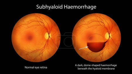 Photo for A subhyaloid hemorrhage on the retina as observed during ophthalmoscopy, an illustration showcasing a dark, dome-shaped hemorrhage beneath the hyaloid membrane. - Royalty Free Image