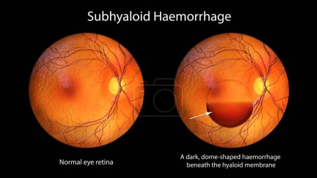 Photo for A subhyaloid hemorrhage on the retina as observed during ophthalmoscopy, 3D illustration showcasing a dark, dome-shaped hemorrhage beneath the hyaloid membrane. - Royalty Free Image