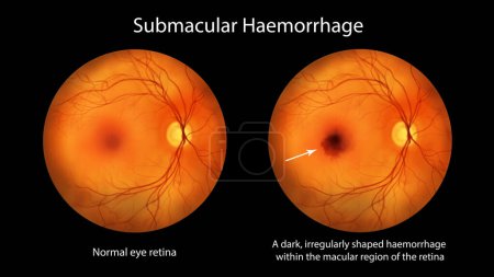 Foto de Ilustración médica de una hemorragia submacular observada durante la oftalmoscopia, que muestra una hemorragia oscura de forma irregular dentro de la región macular de la retina. - Imagen libre de derechos