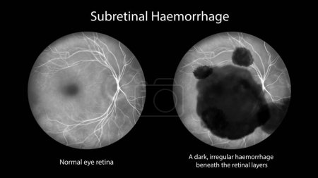 Photo for Medical illustration of a subretinal hemorrhage observed during fluorescein angiography, revealing a dark, irregular hemorrhage beneath the retinal layers. - Royalty Free Image