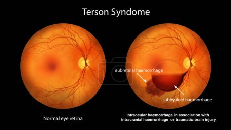 Foto de Una ilustración médica que muestra el síndrome de Terson, revelando hemorragia intraocular observada durante la oftalmoscopia, relacionada con hemorragia intracraneal o lesión cerebral traumática. - Imagen libre de derechos