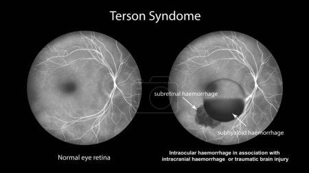 Photo for A medical illustration depicting Terson syndrome, revealing intraocular hemorrhage observed during fluorescein angiography, linked to intracranial hemorrhage or traumatic brain injury. - Royalty Free Image