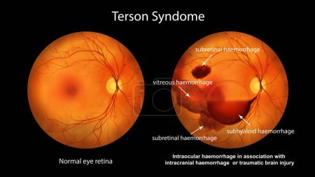 Foto de Una ilustración médica que muestra el síndrome de Terson, revelando hemorragia intraocular observada durante la oftalmoscopia, relacionada con hemorragia intracraneal o lesión cerebral traumática. - Imagen libre de derechos